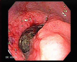 cagastroduodenal12.jpg
