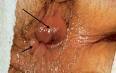 http://www.gastroendoskopi.com/mynet_resimlerim/dishemoroid.jpg