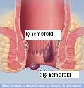 http://www.gastroendoskopi.com/mynet_resimlerim/hemoroidler1.jpg