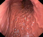 http://www.gastroendoskopi.com/mynet_resimlerim/korpus.jpg