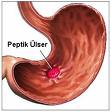 http://www.gastroendoskopi.com/mynet_resimlerim/mide.jpg