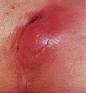 http://www.gastroendoskopi.com/mynet_resimlerim/pilonidal%20abse.jpg